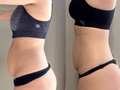 Online Body Contouring Course